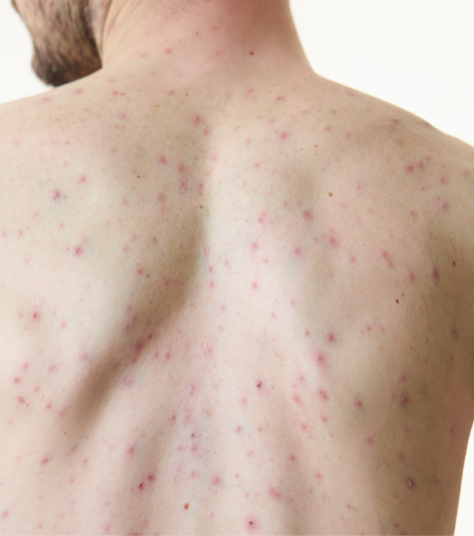 litteken waterpokken volwassene